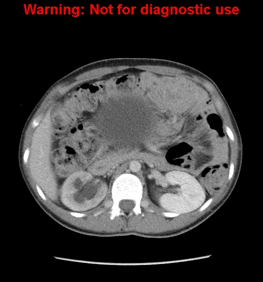 Borderline mucinous cystadenoma of ovary (Radiopaedia 25586-25767 A 4).jpg