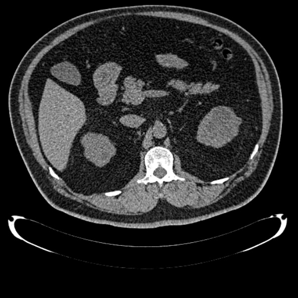 Bosniak renal cyst - type IV (Radiopaedia 24244-24518 Axial non-contrast 128).jpg