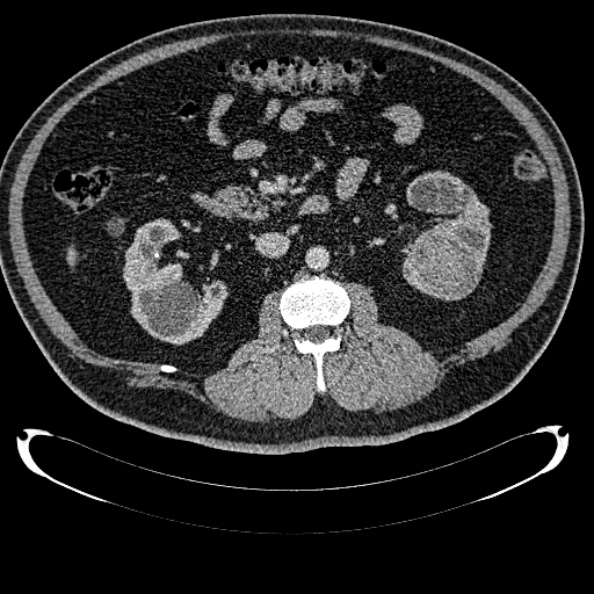 Bosniak renal cyst - type IV (Radiopaedia 24244-24518 C 163).jpg
