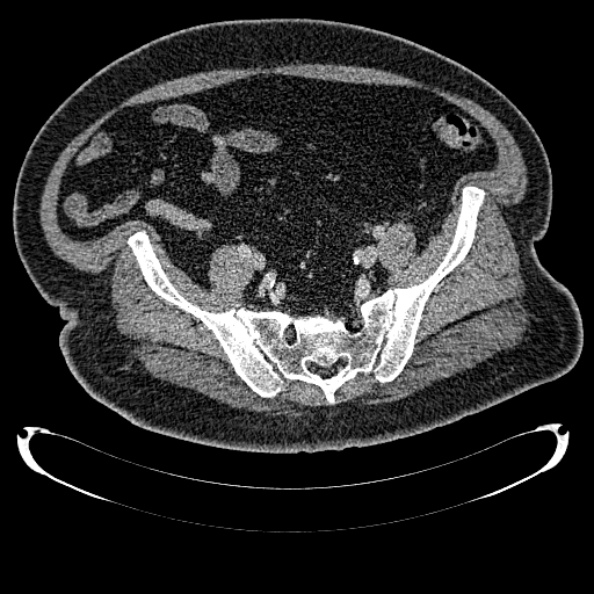 Bosniak renal cyst - type IV (Radiopaedia 24244-24518 C 308).jpg