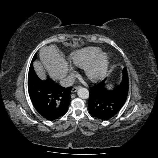 Bovine aortic arch - right internal mammary vein drains into the superior vena cava (Radiopaedia 63296-71875 A 113).jpg