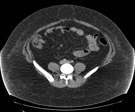 File:Bowel and splenic infarcts in acute lymphocytic leukemia (Radiopaedia 61055-68913 A 84).jpg