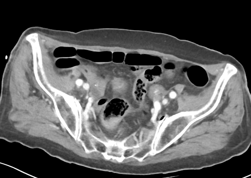 File:Bowel ischemia (Radiopaedia 58273-65382 A 50).png