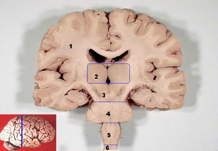 File:Brain (gross pathology) (Radiopaedia 36276).jpg