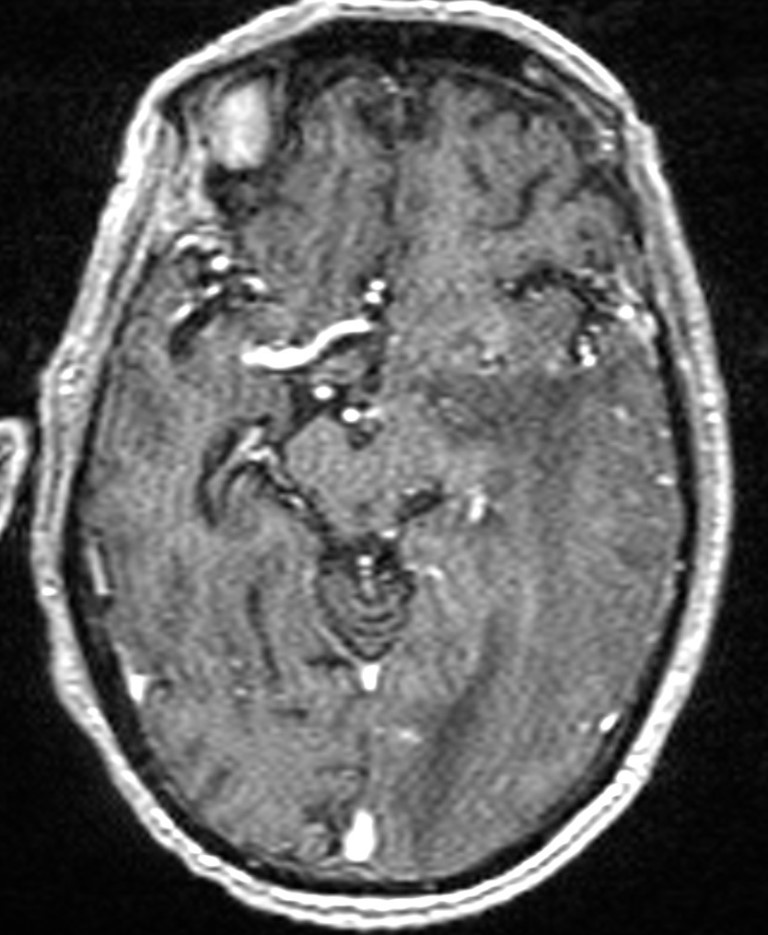 Brain abscess with dual rim sign (Radiopaedia 87566-103938 Axial T1 C+ 73).jpg