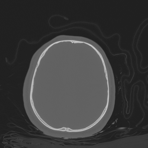 File:Brain contusions, internal carotid artery dissection and base of skull fracture (Radiopaedia 34089-35339 Axial bone window 92).png