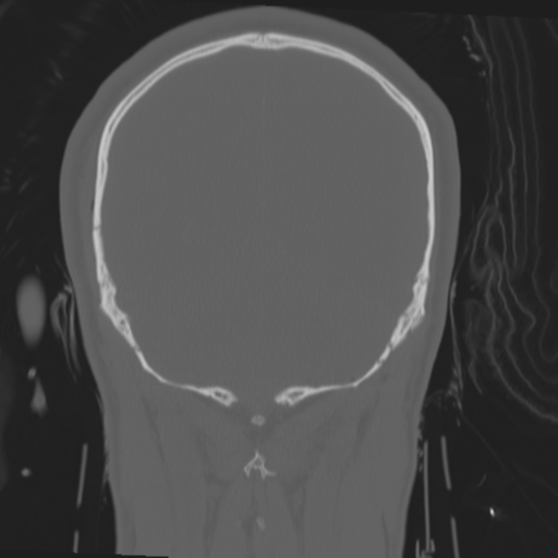File:Brain contusions, internal carotid artery dissection and base of skull fracture (Radiopaedia 34089-35339 Coronal bone window 53).png