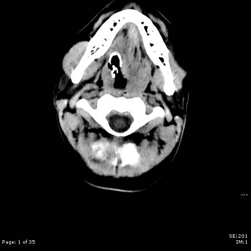 File:Brain death after motor vehicle collision (Radiopaedia 88470-105114 Axial non-contrast 1).jpg