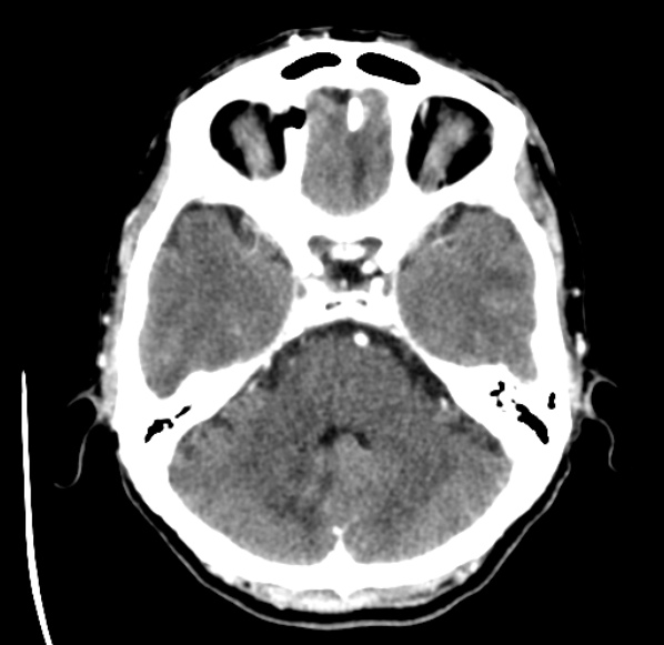 File:Brain metastases from lung cancer (Radiopaedia 24480-24781 Axial C+ delayed 14).jpg