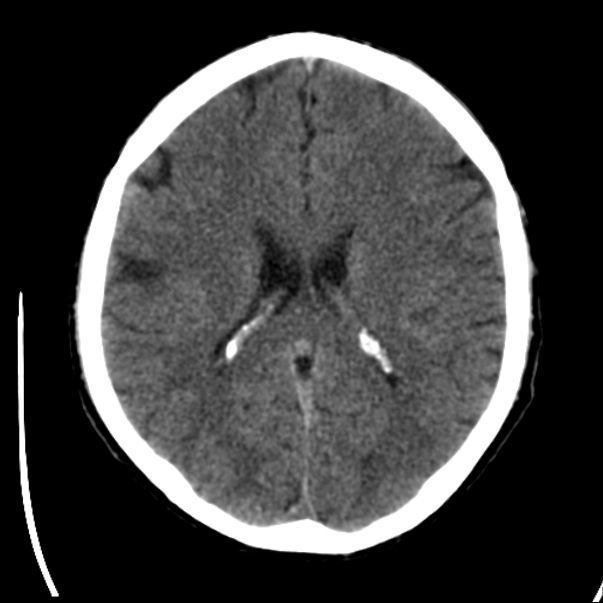 Brain metastases from lung cancer (Radiopaedia 24480-24781 Axial non-contrast 29).jpg