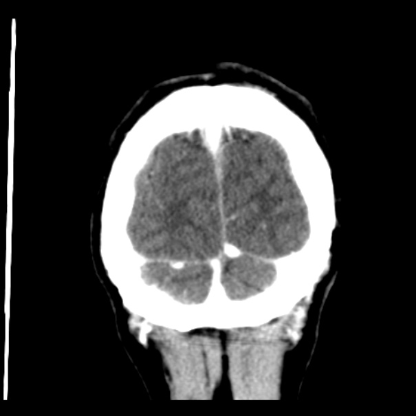 Brain metastases from lung cancer (Radiopaedia 24480-24781 Coronal C+ delayed 57).jpg