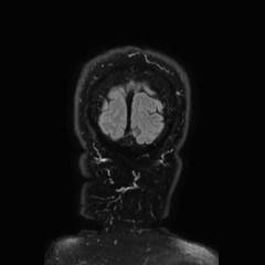 Brain metastases from lung cancer (Radiopaedia 83839-99028 Coronal FLAIR 82).jpg