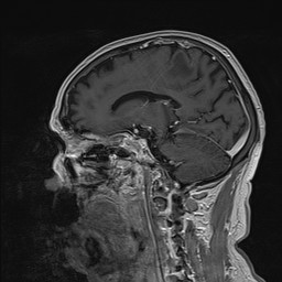 Brain metastasis (Radiopaedia 42617-45761 Sagittal T1 C+ 41).jpg
