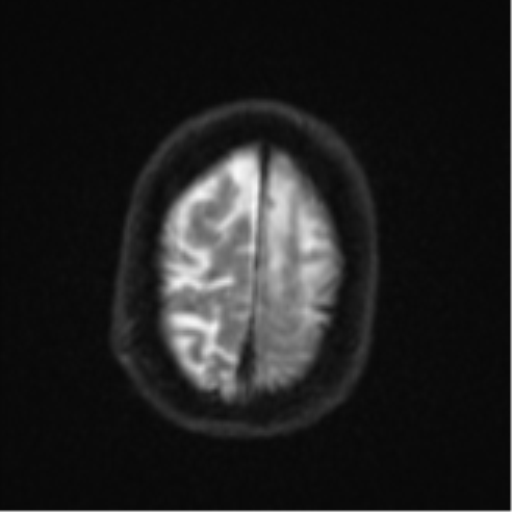 Brain metastasis (lung cancer) (Radiopaedia 48289-53179 Axial DWI 25).png