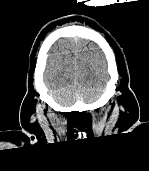 Brainstem hemorrhage (Radiopaedia 81294-94976 Coronal non-contrast 60).jpg
