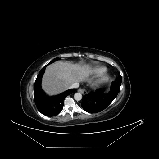 File:Breast cancer pseudocirrhosis with lobar invovlement (Radiopaedia 81080-94670 A 21).jpg