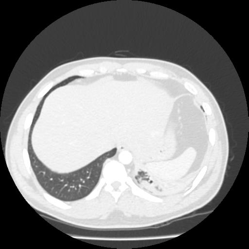 File:Bronchial carcinoid (Radiopaedia 80013-93291 Axial lung window 110).jpg