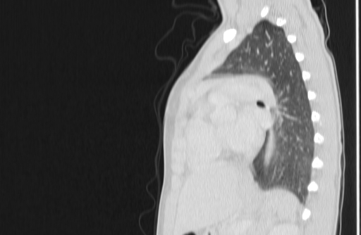 File:Bronchial mucoepidermoid carcinoma (Radiopaedia 57023-63895 Sagittal lung window 116).jpg