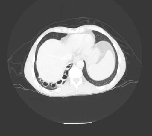 File:Bronchiectasis in Crohn disease (Radiopaedia 60311-67977 Axial lung window 23).jpg