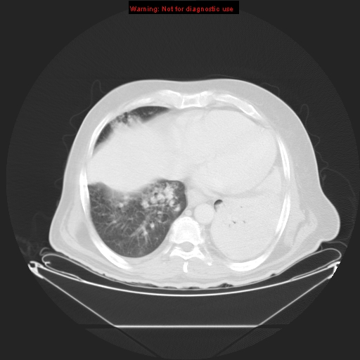 File:Bronchioloalveolar carcinoma (Radiopaedia 9272-9955 Axial lung window 23).jpg