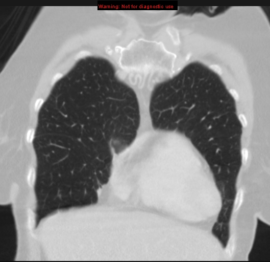 File:Bronchoalveolar carcinoma (BAC) (Radiopaedia 13436-13392 Coronal lung window 13).jpg