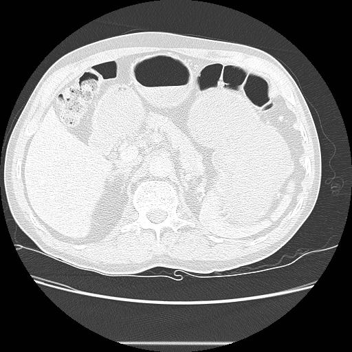 Bronchocele (Radiopaedia 17097-16795 Axial lung window 122).jpg