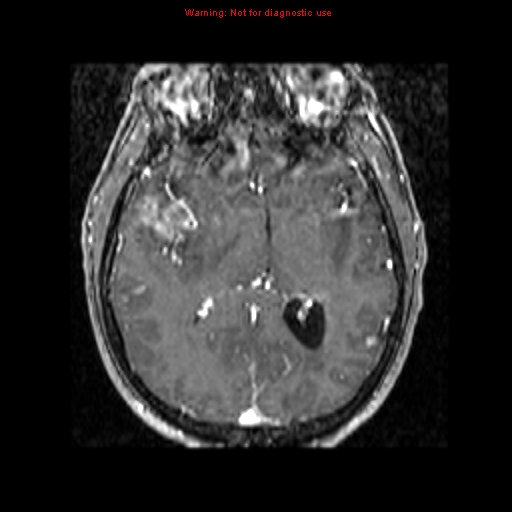 File:Bronchogenic carcinoma brain metastasis (Radiopaedia 9286-9969 Axial T1 C+ 3).jpg
