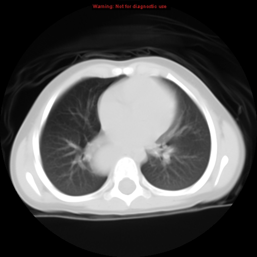 File:Bronchogenic cyst (Radiopaedia 9372-10063 Axial lung window 10).jpg