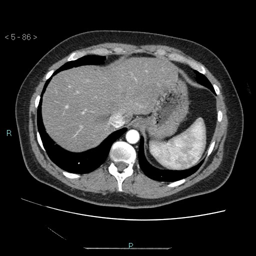 Bronchogenic cyst - posterior mediastinal (Radiopaedia 43885-47364 A 50).jpg
