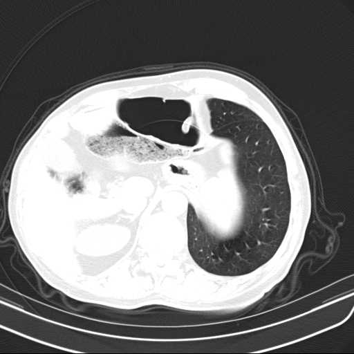 Bronchopleural fistula - postoperative complication (Radiopaedia 21020-20947 Axial lung window 52).jpg