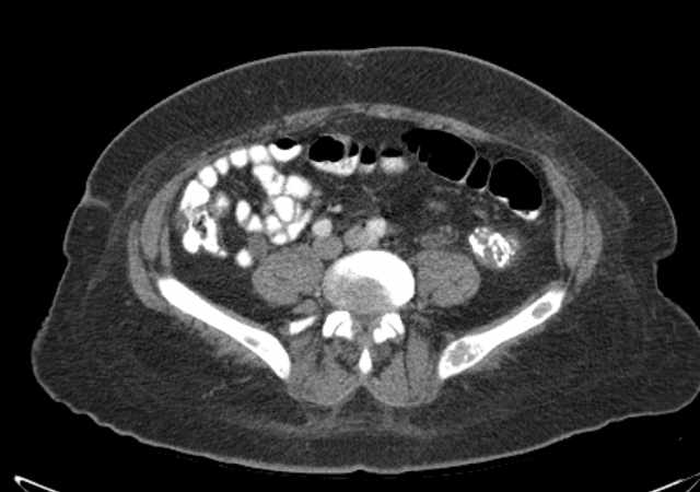 Brown tumors compressing the spinal cord (Radiopaedia 68442-77988 E 81).jpg