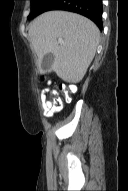 Brown tumors compressing the spinal cord (Radiopaedia 68442-77988 F 13).jpg