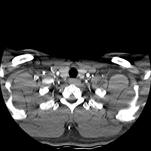 Buccal fat pad arteriovenous malformation (Radiopaedia 70936-81144 D 53).jpg