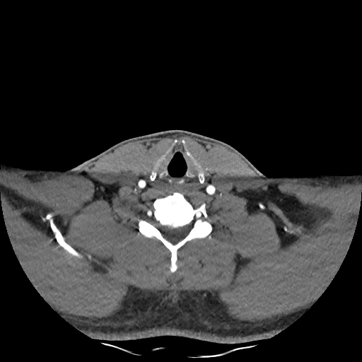 Buccal fat pad arteriovenous malformation (Radiopaedia 70936-81144 D 93).jpg