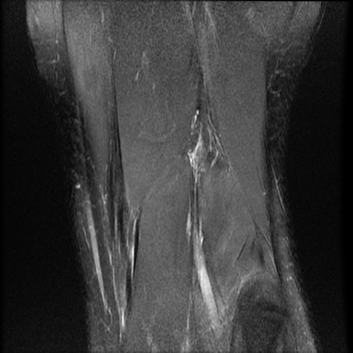 File:Bucket-handle meniscus tear (Radiopaedia 65700-74809 Coronal T2 fat sat 2).jpg