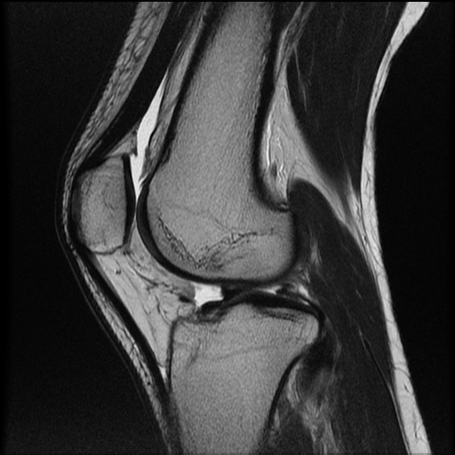 File:Bucket-handle meniscus tear (Radiopaedia 65700-74809 Sagittal T2 16).jpg