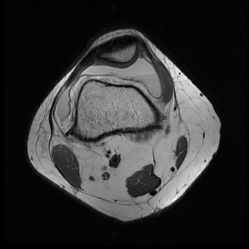 File:Bucket handle meniscus tear (Radiopaedia 56916-63751 Axial PD 3).jpg