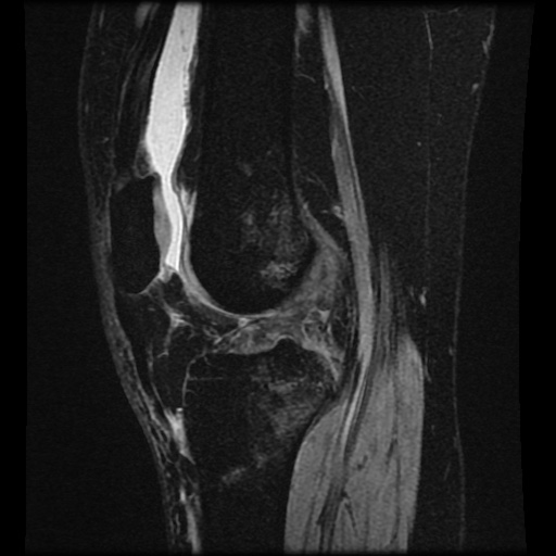 File:Bucket handle meniscus tear (Radiopaedia 56916-63751 H 37).jpg