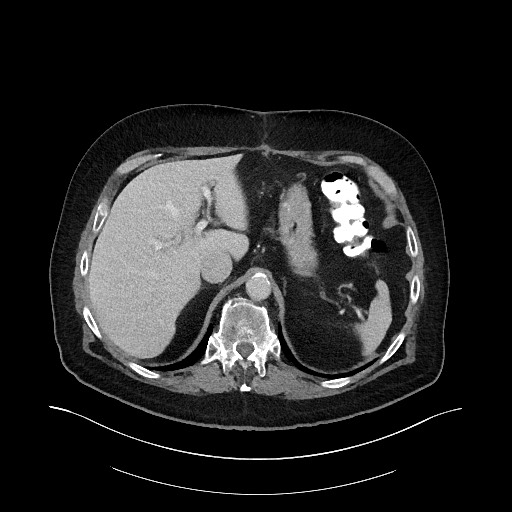 Buried bumper syndrome - gastrostomy tube (Radiopaedia 63843-72575 A 10).jpg