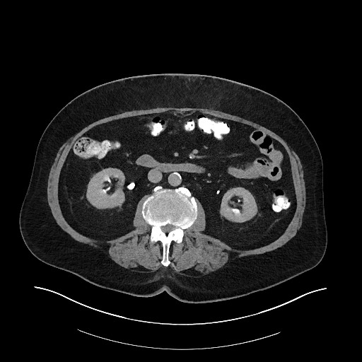 File:Buried bumper syndrome - gastrostomy tube (Radiopaedia 63843-72575 Axial Inject 21).jpg