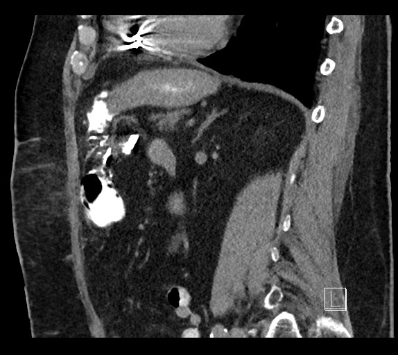 Buried bumper syndrome - gastrostomy tube (Radiopaedia 63843-72577 Sagittal Inject 45).jpg