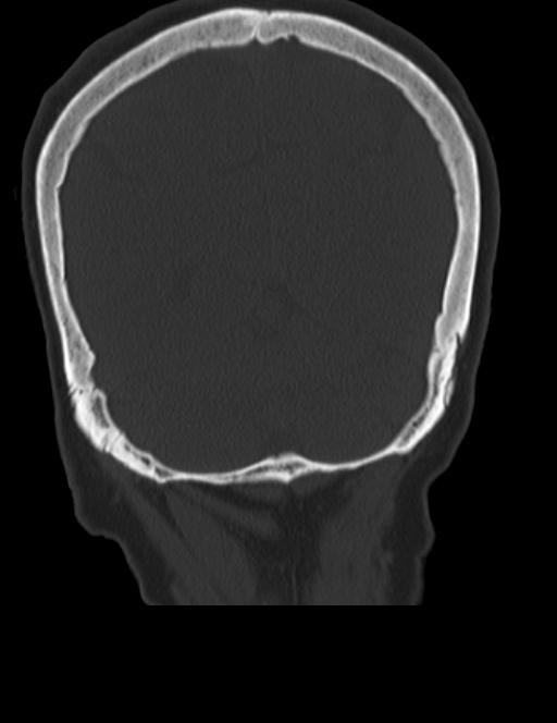 Burnt-out meningioma (Radiopaedia 51557-57337 Coronal bone window 43).jpg