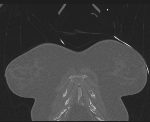 Burst fracture - thoracic spine (Radiopaedia 30238-30865 Coronal bone window 15).jpg