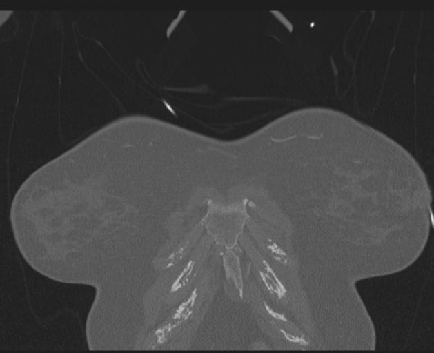 Burst fracture - thoracic spine (Radiopaedia 30238-30865 Coronal bone window 17).jpg