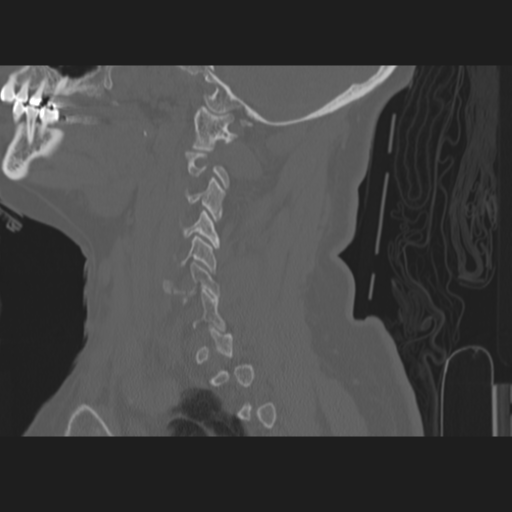 C2 fracture (Radiopaedia 34091-35341 Sagittal bone window 52).png