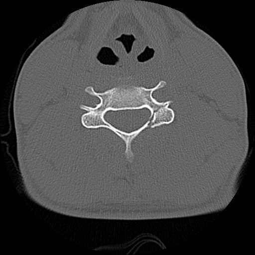 File:C5 facet fracture (Radiopaedia 58374-65499 Axial bone window 52).jpg