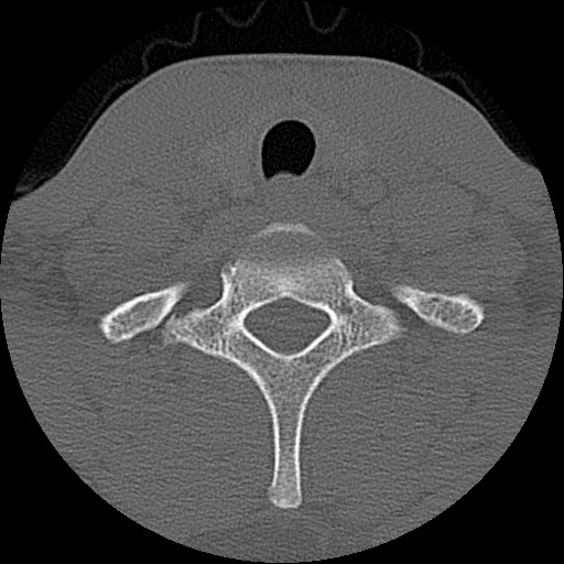 File:C5 facet fracture (Radiopaedia 58374-65499 Axial bone window 79).jpg