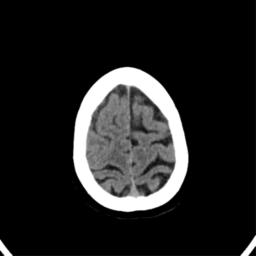 File:CNS Lymphoma (Radiopaedia 44198-47794 Axial non-contrast 32).png