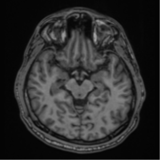 CNS vasculitis (Radiopaedia 55715-62263 Axial T1 14).png
