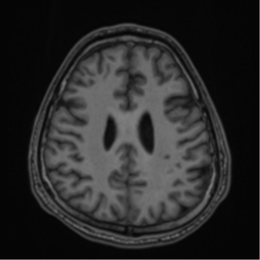CNS vasculitis (Radiopaedia 55715-62263 Axial T1 60).png